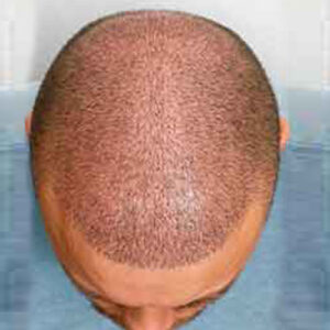 Hair Transplantation after