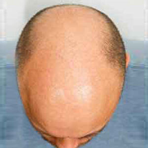 Hair Transplantation before