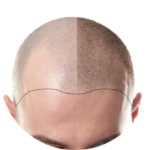 A visual representation of scalp density restoration, demonstrating the results of a hair retention treatment.